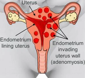 What Is the Difference Between Endometriosis and Adenomyosis?
